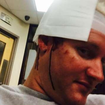 Londoner Shawn Matthew Evans injured in Grand Bend assault. (Photo courtesy of Shawn Matthew Evans via Instagram)